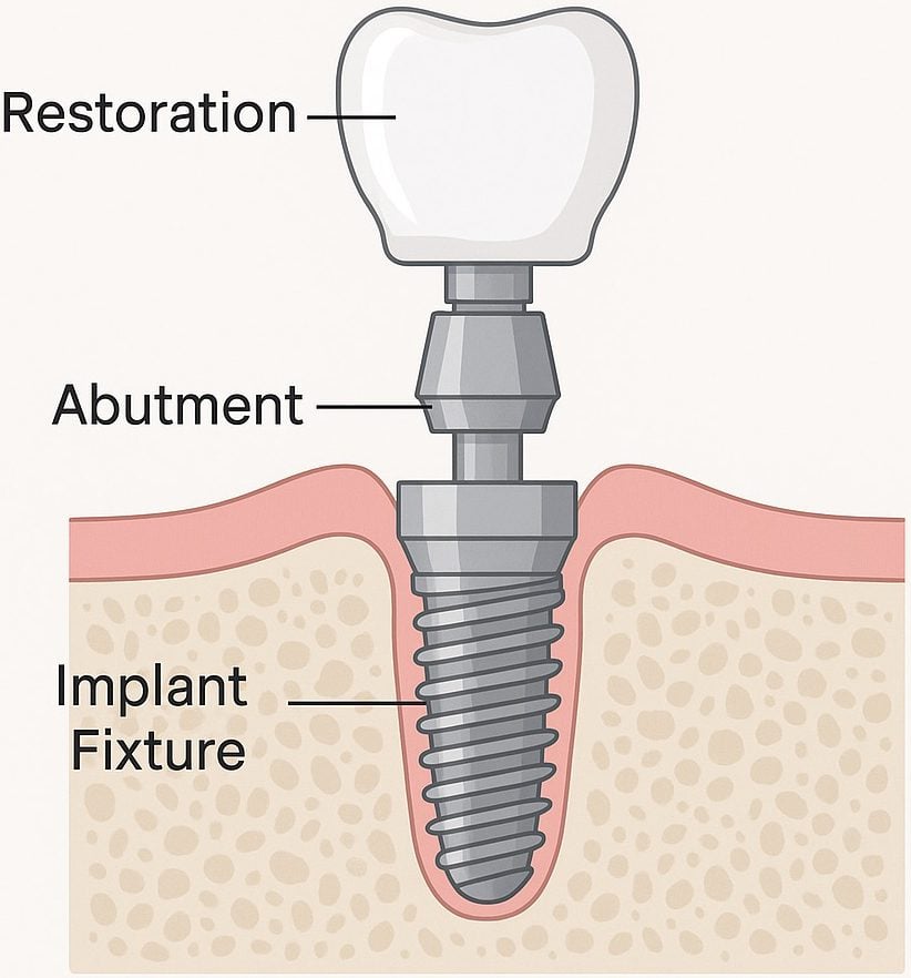 Diagram showing the three parts of a dental implant: the implant fixture (a titanium screw embedded in bone), the abutment (connector), and the restoration (tooth-colored crown).
