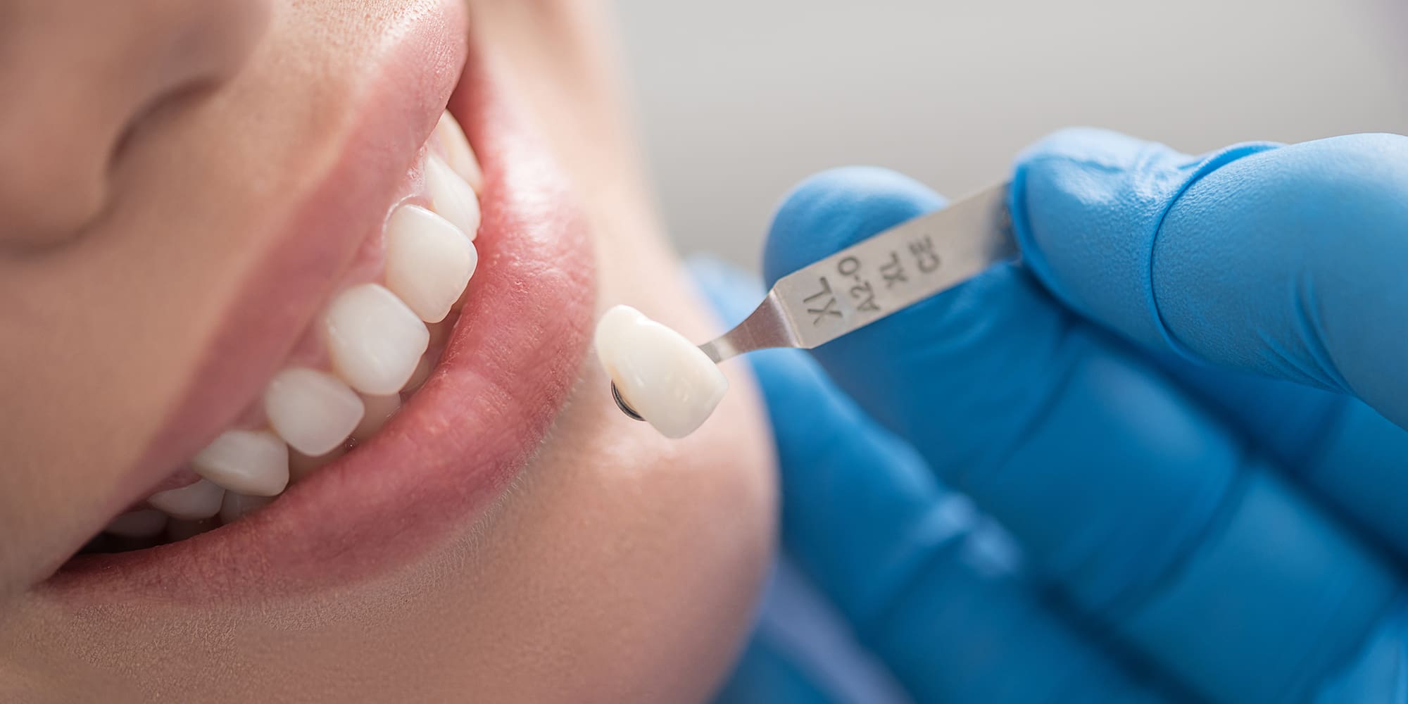 Dental Crowns and Their Role in Tooth Restoration