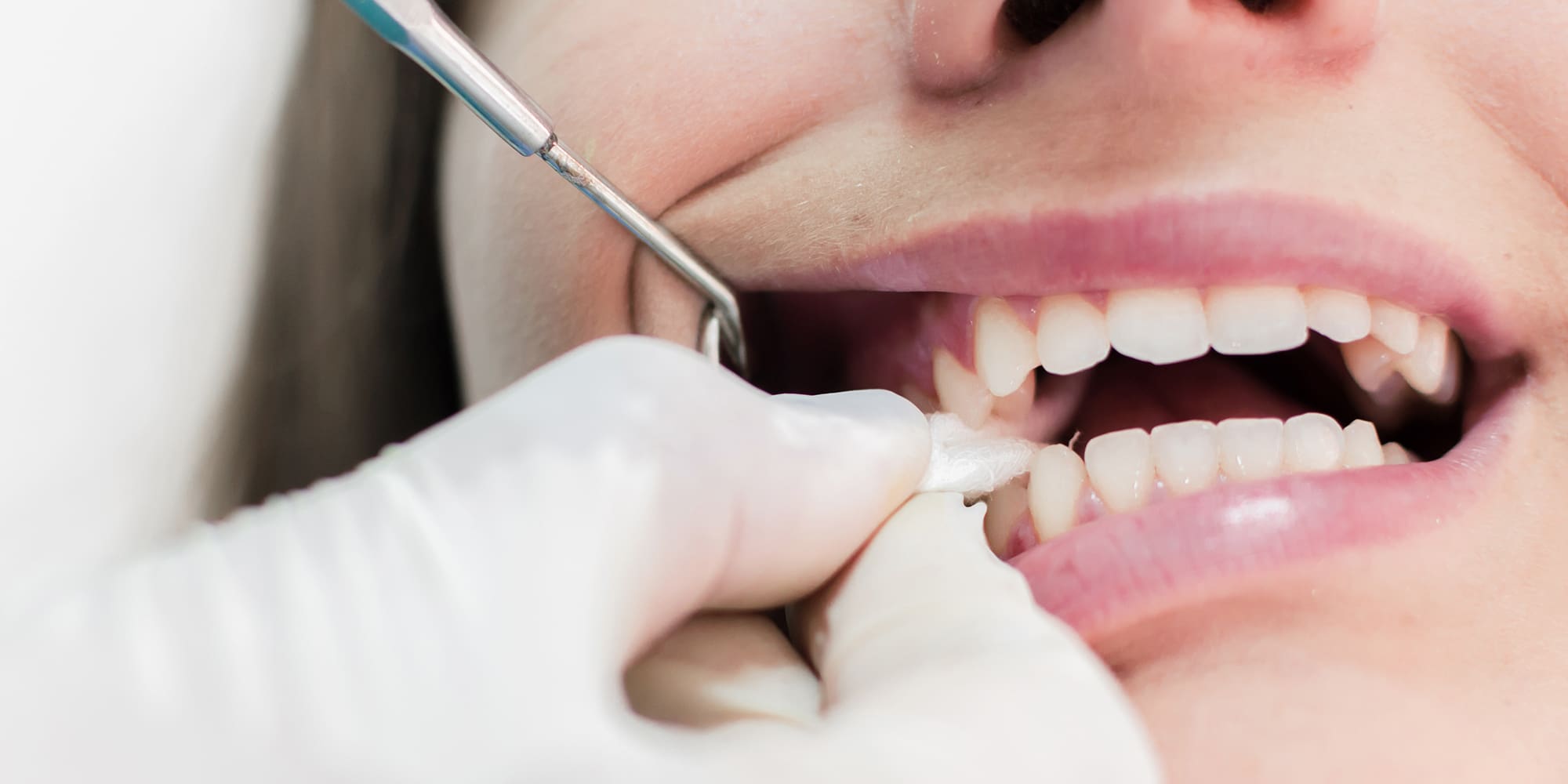 Tooth Extraction Aftercare: When Gauze Is Needed and When It Is Not