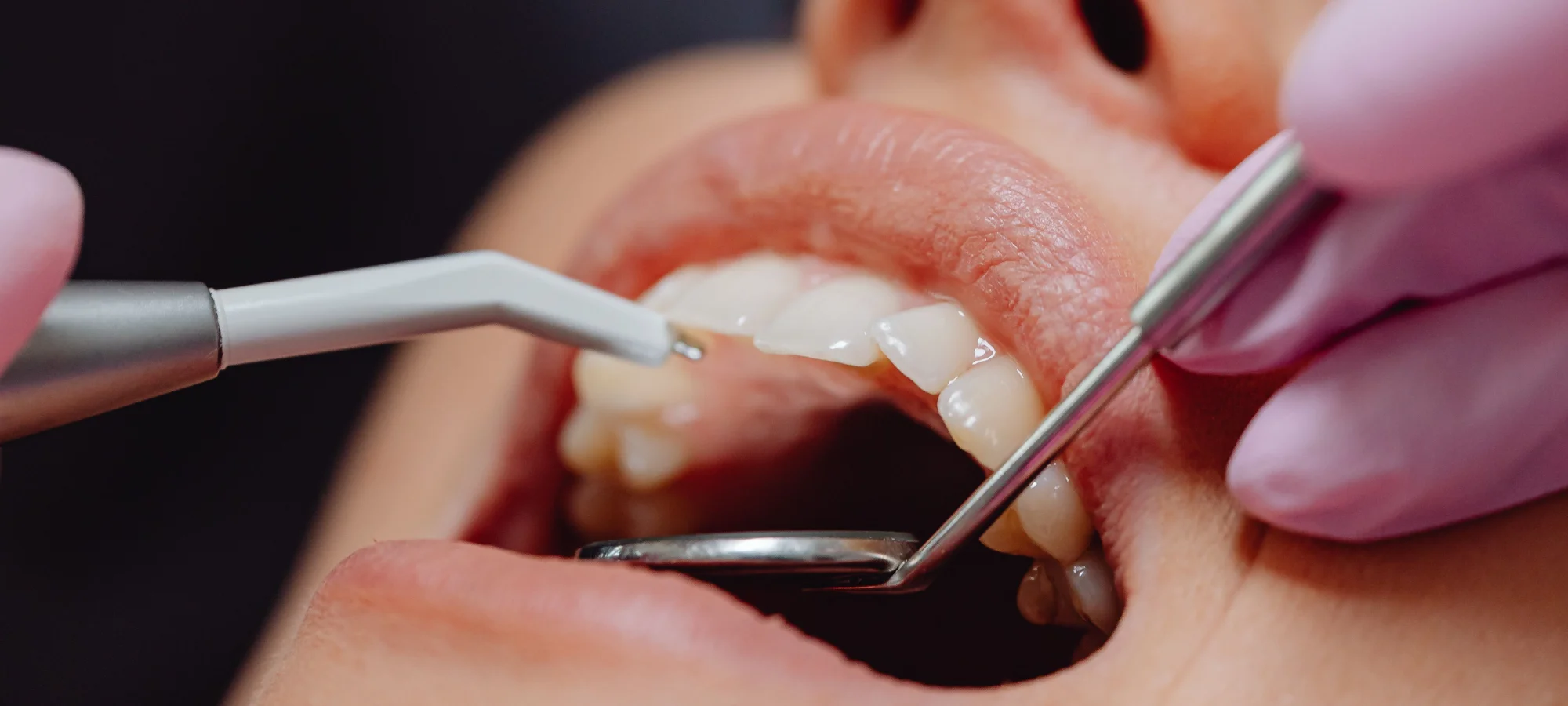 Broda Dental Patient from Louisville