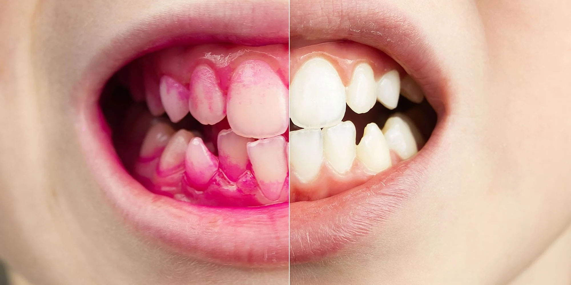How to Use Plaque Disclosing Tablets
